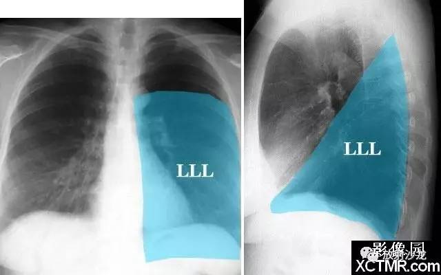 左肺肺叶,段及叶间裂胸膜常规x线胸片定位