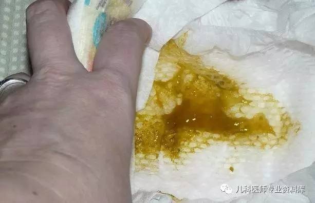 宝宝大便色彩奶瓣泡沫黏液的超全解析便便真图敏感者慎入