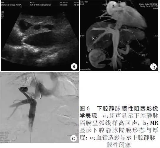 专家共识布加综合征的亚型分型