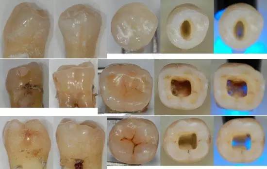 各牙齿的大概的开髓形态