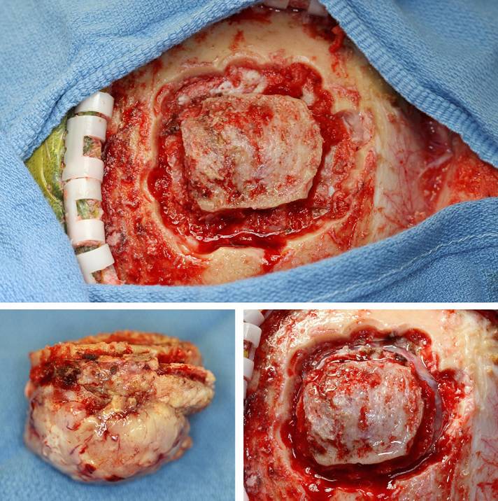 凸面脑膜瘤手术策略与技巧 the neurosurgical atlas全文翻译