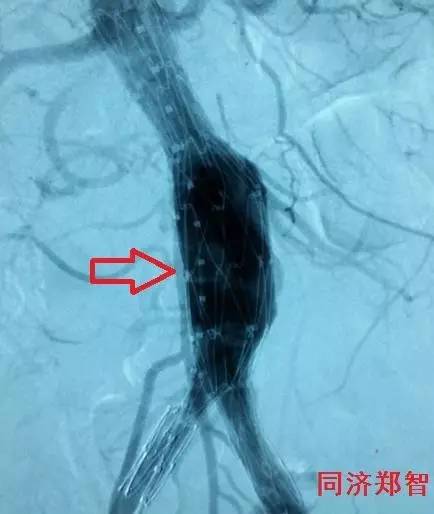 史上最清晰的四大主动脉瘤!