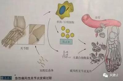 痛了这么多回你不会连痛风的发作机制都不清楚吧