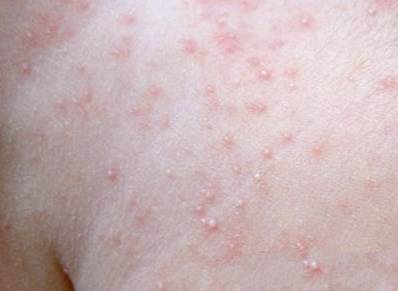 夏天到了!如何应对和区别湿疹痱子?
