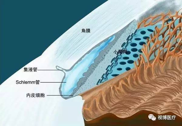 选择性激光小梁成形术治疗开角型青光眼患者问答