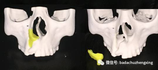 唇腭裂患者,最新的3d打印技术可以帮到你!