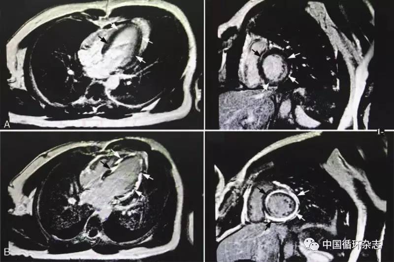 两例患者的心脏核磁共振结果,可见斑片状的延迟强化