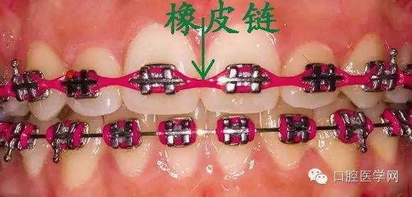 牙齿矫正知识科普帖:正畸牙套装置部件详解(附图片)