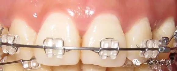 并且因避免了带环厚度给牙齿带来接触不够紧密,而引发拆除矫治器后的