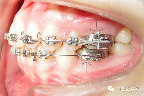 牙齿矫正知识科普帖:正畸牙套装置部件详解(附图片)