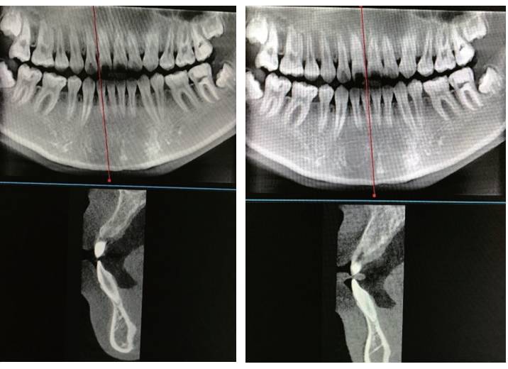图13 治疗结束锥形束ct显示上颌前牙唇侧骨板连续完整