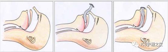 母婴 正文  ——节选自"icu护理之家512说出你的感动" 口咽通气管放置