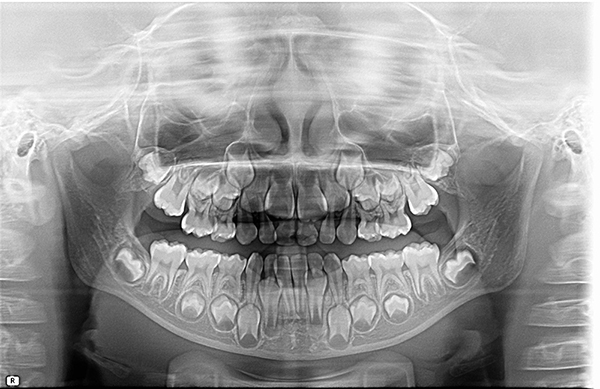 孩子的牙齿就像一座冰山,表面的危险一目了然 ,但是在牙龈内,有没有多