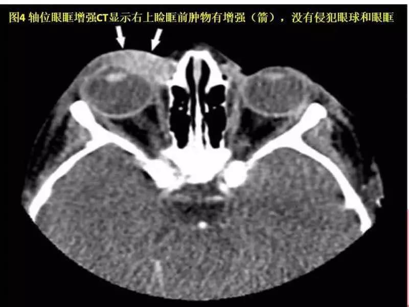 病例讨论 第94期丨眼眶继发淋巴瘤