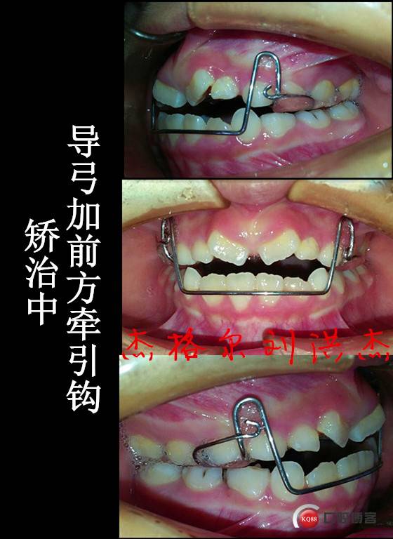 病例分享反合系列矫治之替牙期矫治