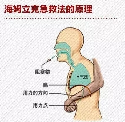 能说话时,说明可能是有异物堵住了呼吸道,应立即采取 哈姆立克急救法