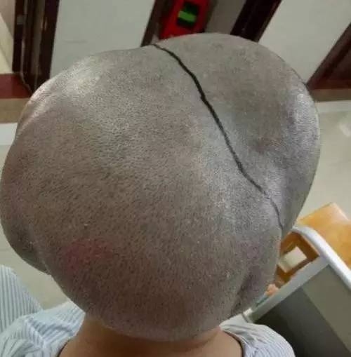 广州女子头上带瘤三十余年,脑袋是正常人