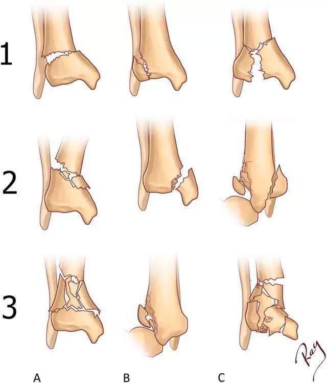 图 胫骨远端 ao/ota 分型,a 关节外,b 部分关节内,c 完全关节内