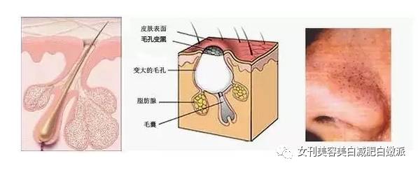 变成角栓之后就会撑大你的毛孔                 氧化,形成新的黑头