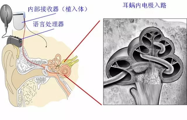 【超详细】人工耳蜗简介—乐清惠耳助听器