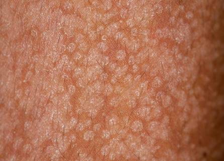 称花斑癣,俗称汗斑,是由马拉色菌感染表皮角质层引起的一种浅表真菌病