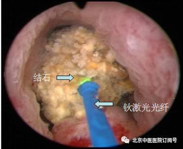 疼死人的输尿管结石,选对治疗方法很重要!