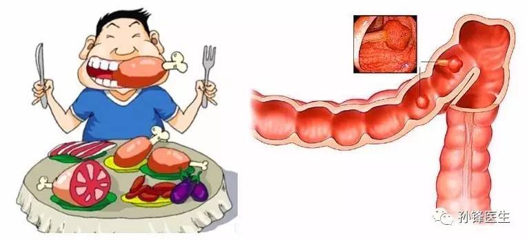 医学科普︱大鱼大肉的好生活，引来了大肠里的坏息肉!_搜狐健康_搜狐网