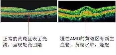 健康|眼底长"黄斑"是病吗?