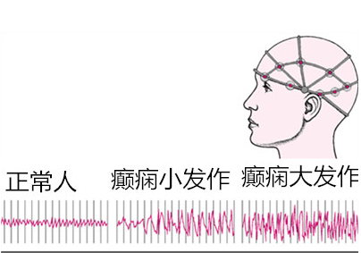 专家指导：应对小发作的有效措施