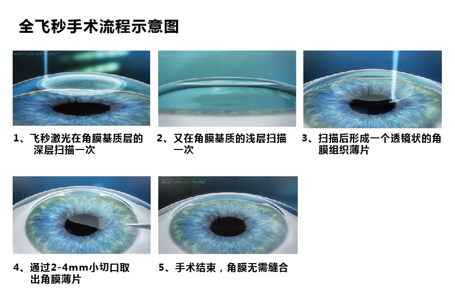 全飞秒近视手术的原理_全飞秒(3)