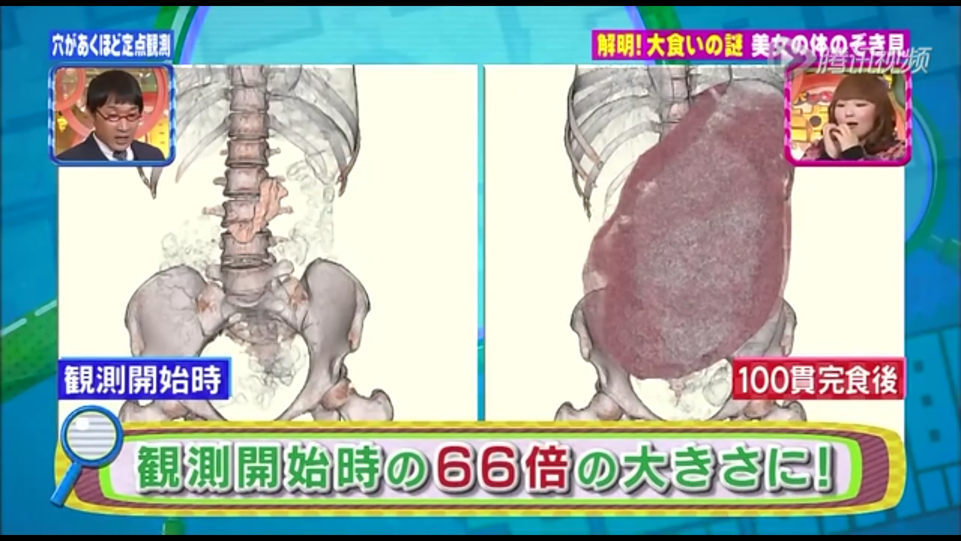 日本大胃王木下近况：有超出常人的胃也会长胖！被疑做医美演戏