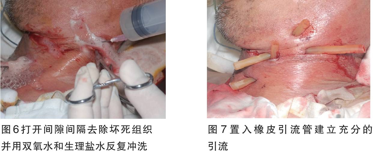 颌面及全身多部位严重间隙感染的多学科综合治疗——李志刚医师