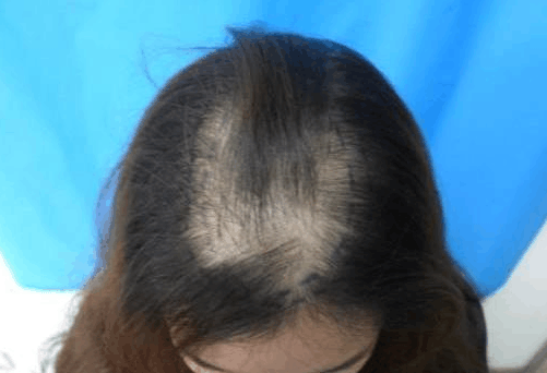 秃顶早期征兆, 做好预防, 不做脱发人