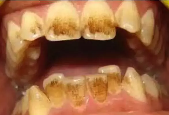 亿博电竞官网平台牙齿根部牙龈发黑是怎么回事？