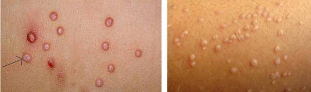 图六:丘疹(plapule):左侧为典型丘疹,右侧为扁平疣