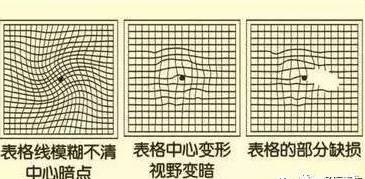 一张图测痴呆,脑梗,视力,50岁后每年都要测!太实用了