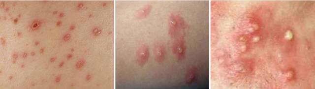 图九:左图为斑丘疹(maculopapule,即介于斑疹和丘疹之间的稍隆起的
