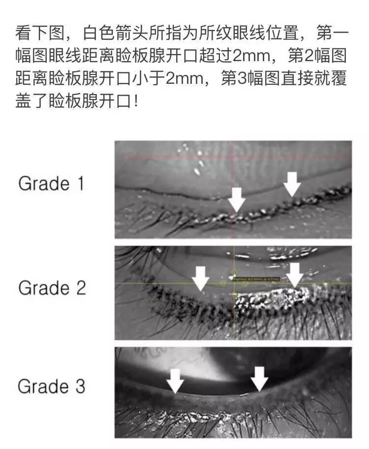 什么是睑板腺功能障碍(mgd?