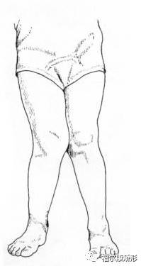 x型腿也称膝外翻,是指双腿并拢膝盖相抵时,两脚内踝无法靠拢.