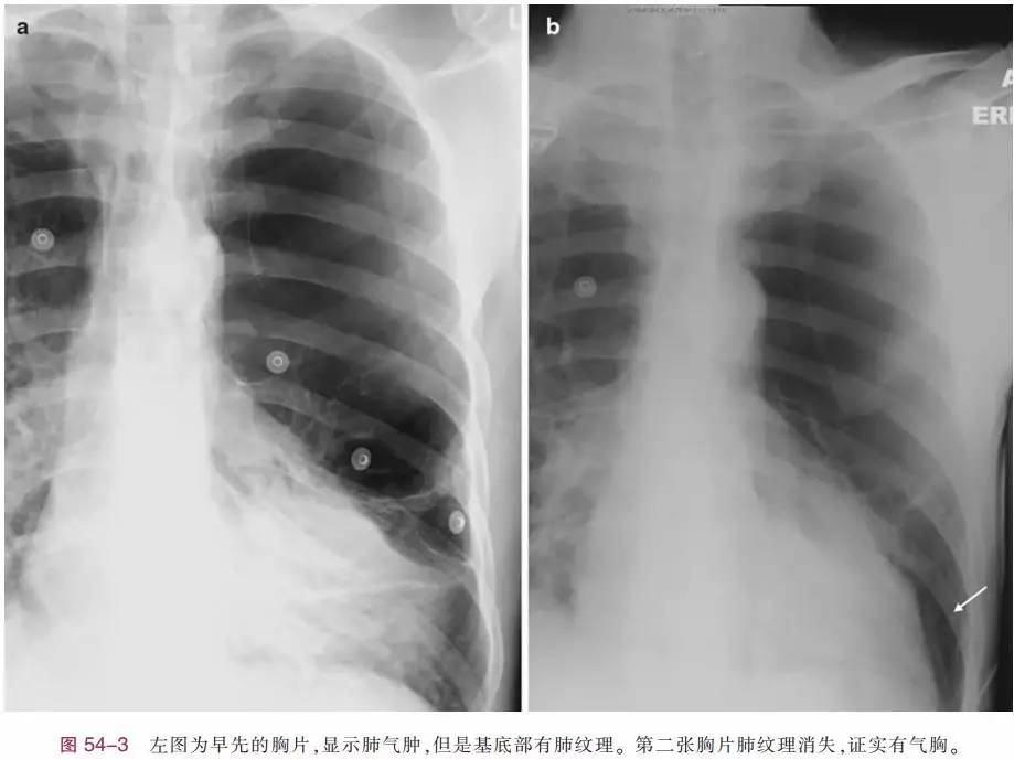 大量气胸在pa,ap和卧位胸片上都容易发现,可能引起全肺不张,张力性