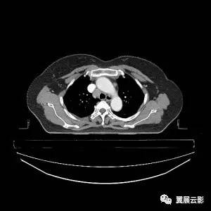 中央型肺癌的诊断与鉴别