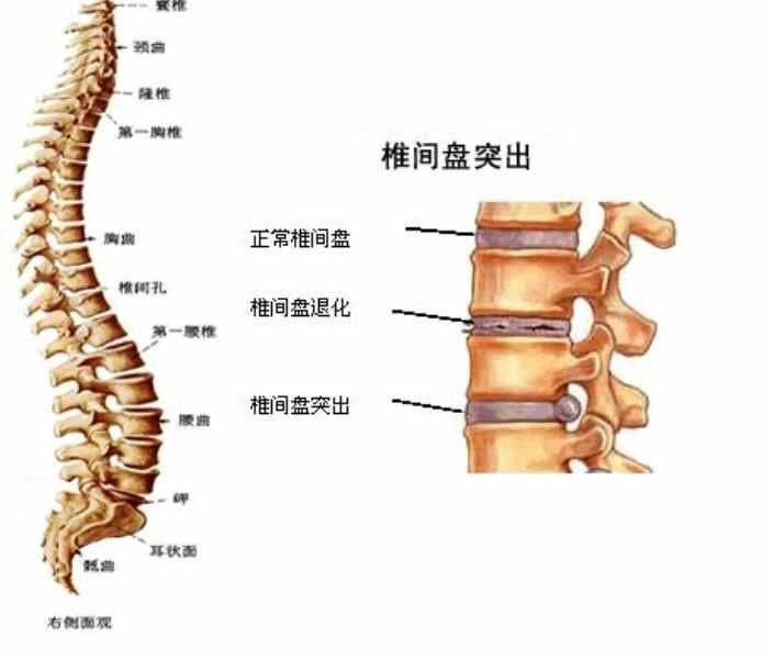 得了腰椎间盘突出何时该养何时该锻炼？