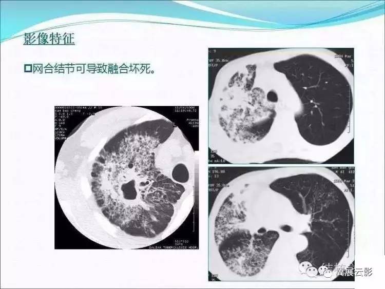 肺结核——上中 "活动性肺结核ct判定及非典型肺结核分析"