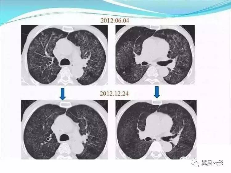 多表示病变处于活动期,当然空洞,陈旧性结核