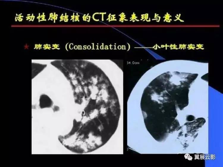 以上五个征象,多表示病变处于活动期,当然空洞,陈旧性结核里也可以