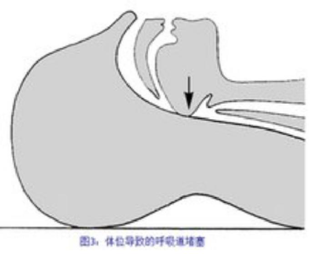 请看图,什么是舌后坠