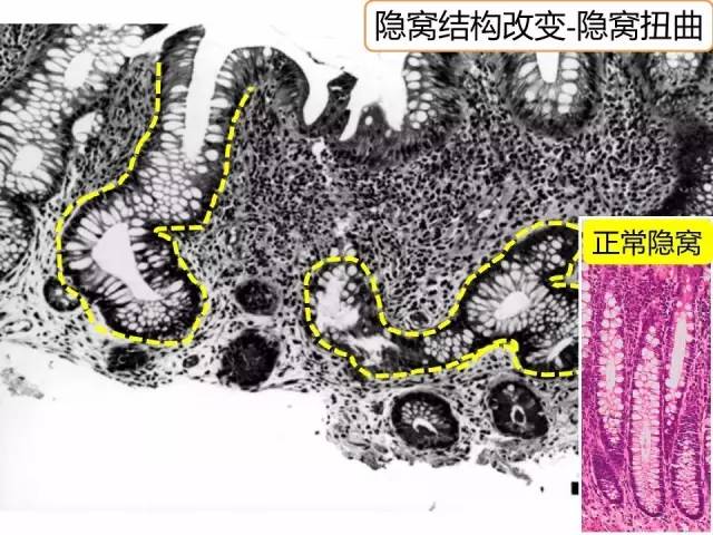 表面不规则(surface irregularity:隐窝开口增宽,黏膜表面不平,呈