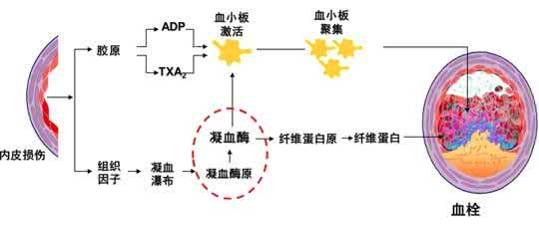 脑血栓的原理_知识│脑梗死 脑血栓及脑出血的区别