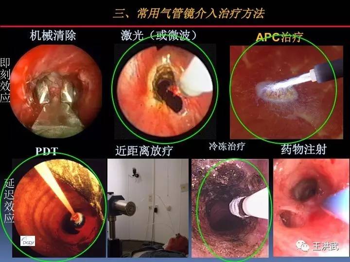 【组图】洪武讲堂丨co2冷冻在支气管镜下的应用