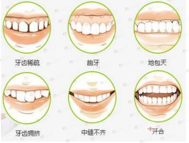 牙齿矫正必须知道的三件事 不看后悔